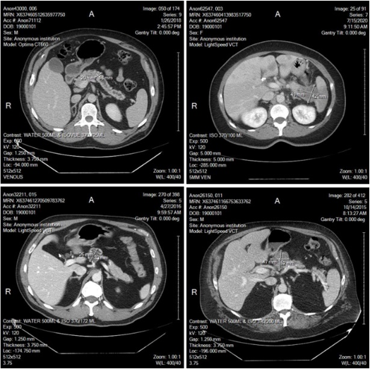 Images show examples of CT images recently annotated by a radiologist to support medical imaging research to identify quantitative image markers to help diagnosis of pancreatic tumors. Based on RECIST guidelines, two maximum perpendicular diameters of the central tumor region are measured and marked (as shown in images). In these four images, two tumors (on the top) are verified pancreatic adenocarcinoma, while two tumors (on the bottom) are intraductal papillary mucinous neoplasm (left) and serous cystadenomas (right), which currently are benign, but have a risk of progressing to pancreatic cancer.